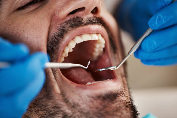 Best Emergency Dental Care for Broken or Chipped Teeth in Dundalk, MD